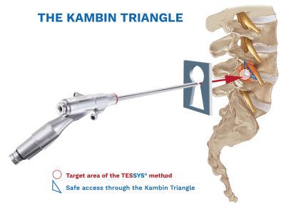 KambinTriangle with keyhole_NEW